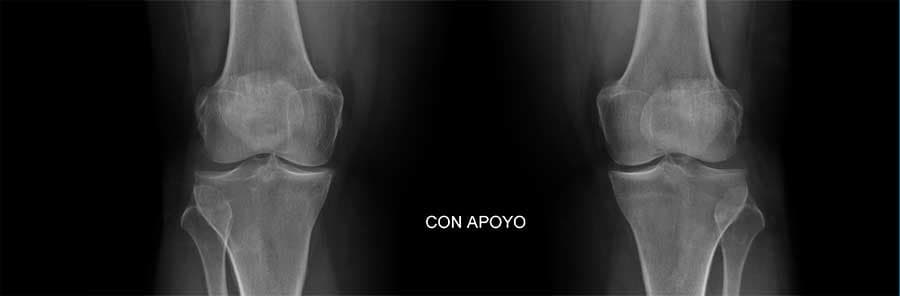 Infiltraciones médicas para dolor crónico en Medellín