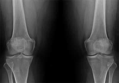 Viscosuplementación de rodilla en Medellín para aliviar dolor articular