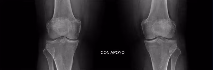 Infiltraciones médicas y viscosuplementación para dolor articular de rodilla en MedellÃn